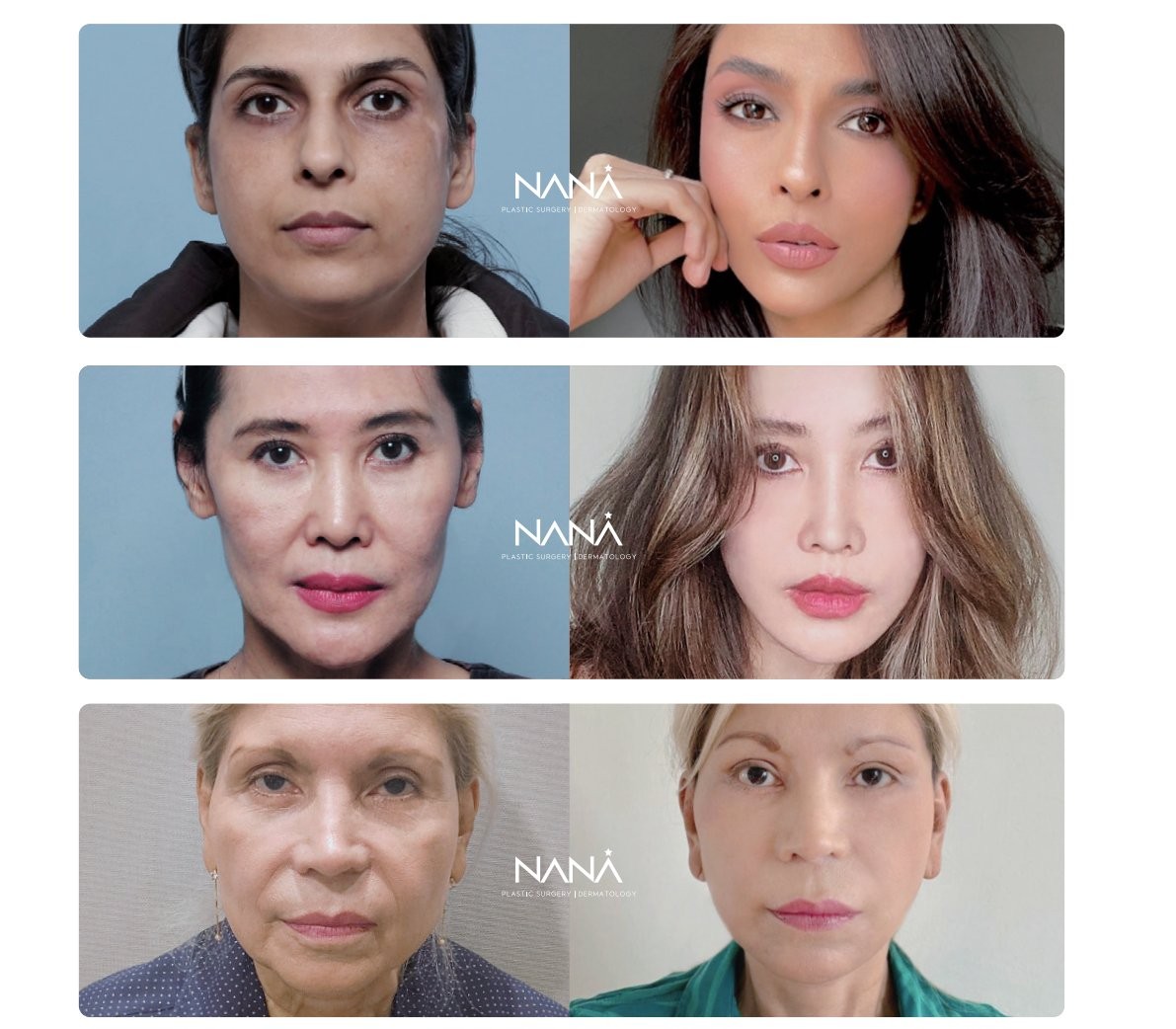 NANA Facelift before and after gallery