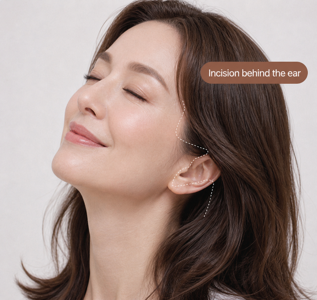 NANA facelift incision technique behind the ear