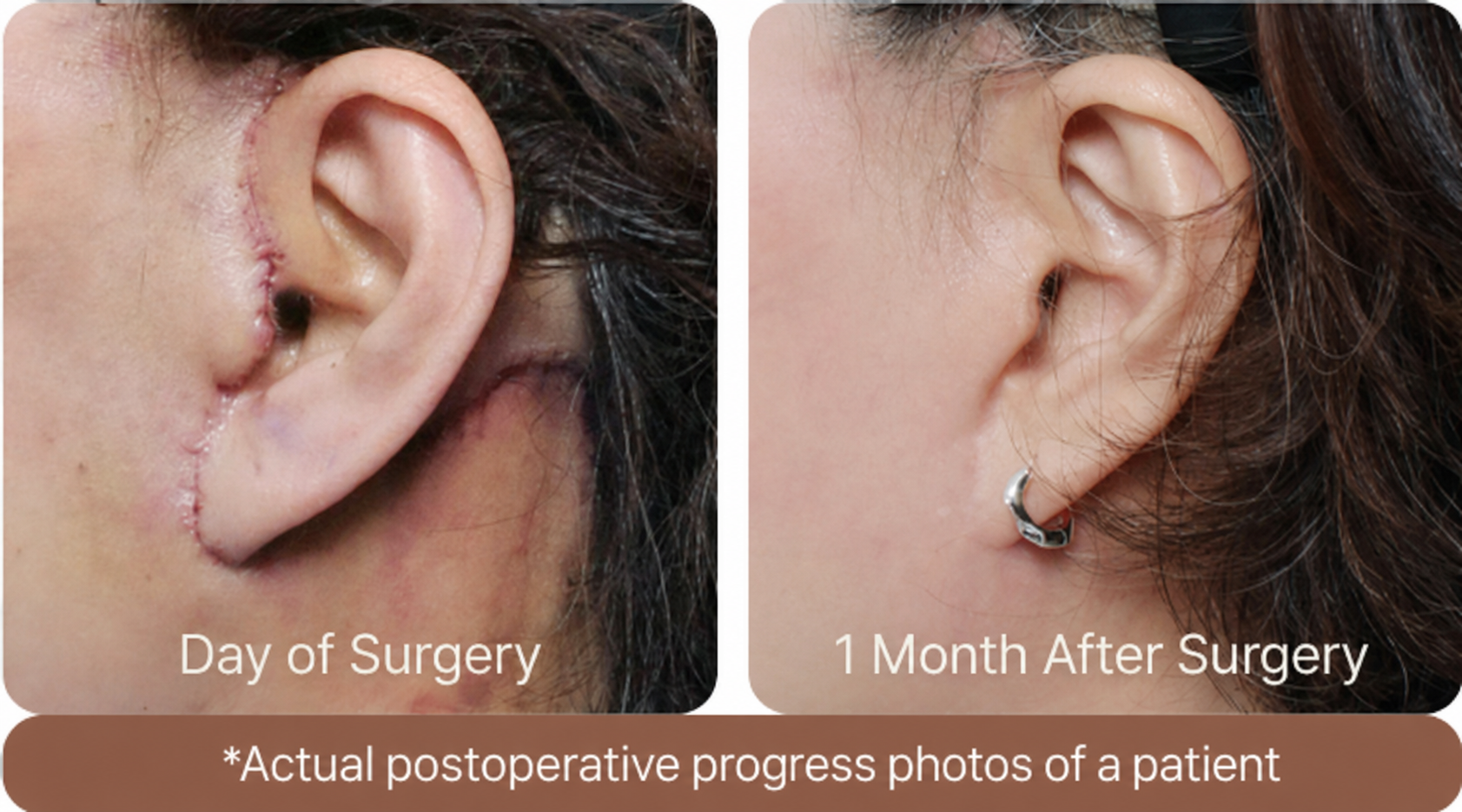 NANA facelift incision healing comparison — day of surgery vs 1 month after