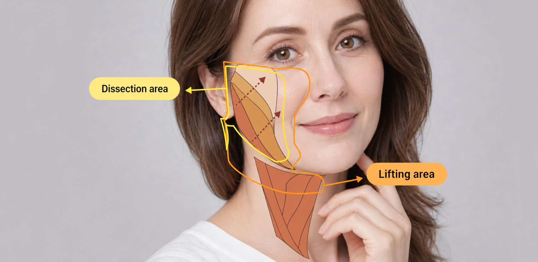 NANA Triple Deep Plane facelift dissection and lifting range